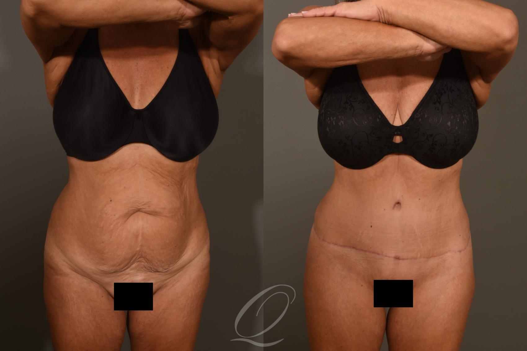 Tummy Tuck Case 383 Before & After View #1 | Serving Rochester, Syracuse & Buffalo, NY | Quatela Center for Plastic Surgery