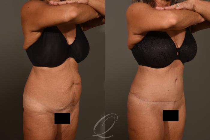 Tummy Tuck Case 383 Before & After View #2 | Serving Rochester, Syracuse & Buffalo, NY | Quatela Center for Plastic Surgery