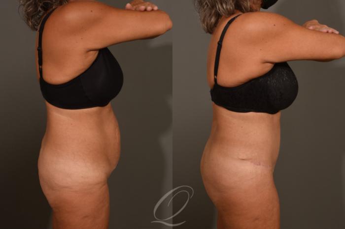 Tummy Tuck Case 383 Before & After View #3 | Serving Rochester, Syracuse & Buffalo, NY | Quatela Center for Plastic Surgery