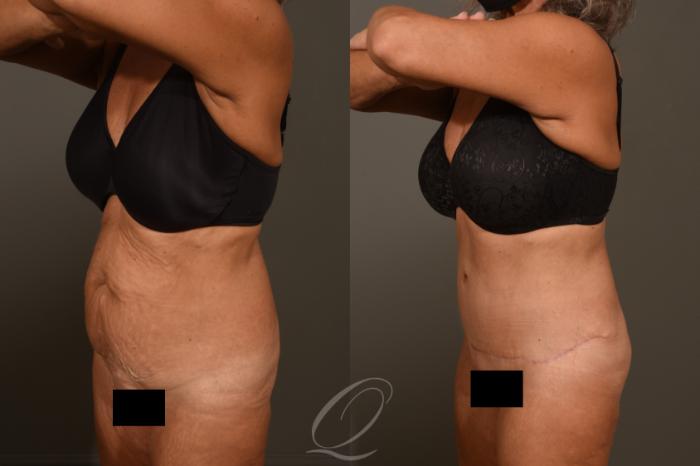 Tummy Tuck Case 383 Before & After View #4 | Serving Rochester, Syracuse & Buffalo, NY | Quatela Center for Plastic Surgery