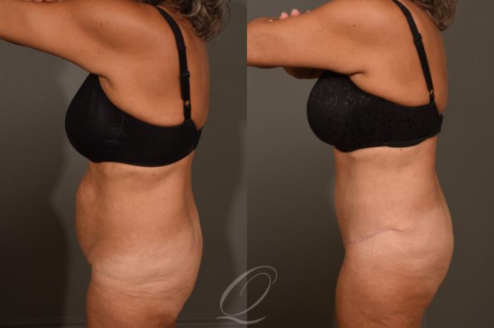 Tummy Tuck Case 383 Before & After View #5 | Serving Rochester, Syracuse & Buffalo, NY | Quatela Center for Plastic Surgery