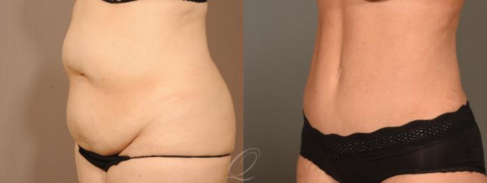 Tummy Tuck Case 394 Before & After Left Oblique | Serving Rochester, Syracuse & Buffalo, NY | Quatela Center for Plastic Surgery