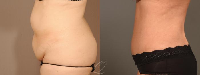 Tummy Tuck Case 394 Before & After Left Side | Serving Rochester, Syracuse & Buffalo, NY | Quatela Center for Plastic Surgery