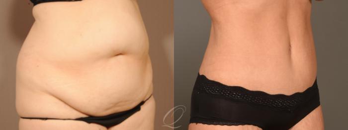 Tummy Tuck Case 394 Before & After Right Oblique | Serving Rochester, Syracuse & Buffalo, NY | Quatela Center for Plastic Surgery