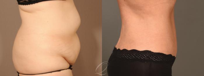 Tummy Tuck Case 394 Before & After Right Side | Serving Rochester, Syracuse & Buffalo, NY | Quatela Center for Plastic Surgery