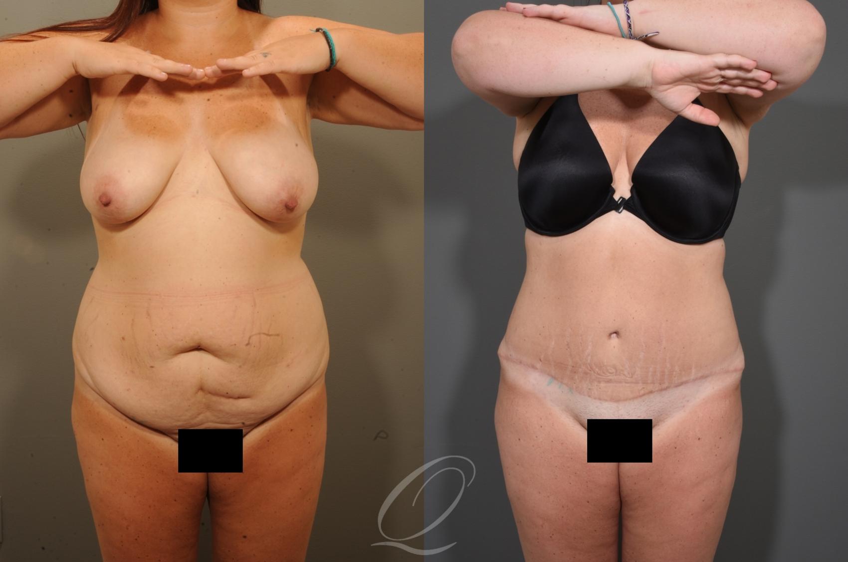 Tummy Tuck Case 404 Before & After Front | Serving Rochester, Syracuse & Buffalo, NY | Quatela Center for Plastic Surgery