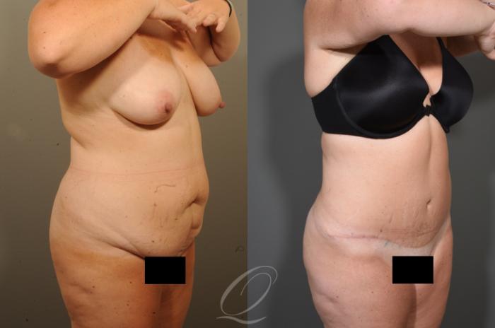 Tummy Tuck Case 404 Before & After Right Oblique | Serving Rochester, Syracuse & Buffalo, NY | Quatela Center for Plastic Surgery