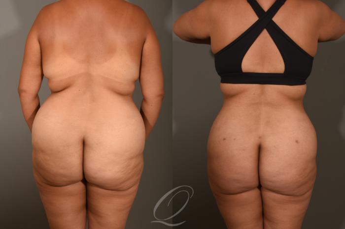 Tummy Tuck Case 405 Before & After Back | Serving Rochester, Syracuse & Buffalo, NY | Quatela Center for Plastic Surgery