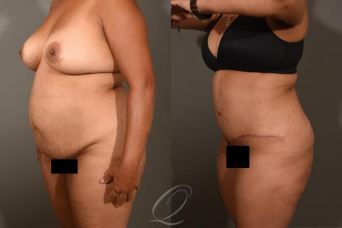 Tummy Tuck Case 405 Before & After Left Oblique | Serving Rochester, Syracuse & Buffalo, NY | Quatela Center for Plastic Surgery