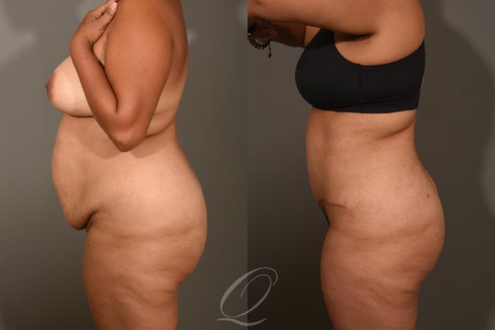 Tummy Tuck Case 405 Before & After Left Side | Serving Rochester, Syracuse & Buffalo, NY | Quatela Center for Plastic Surgery