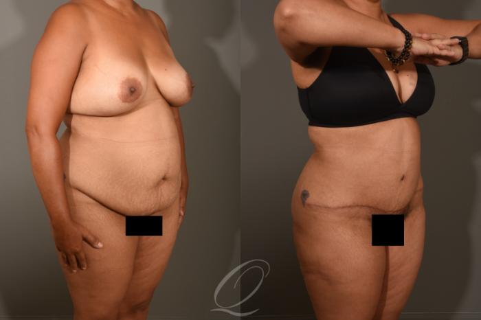 Tummy Tuck Case 405 Before & After Right Oblique | Serving Rochester, Syracuse & Buffalo, NY | Quatela Center for Plastic Surgery