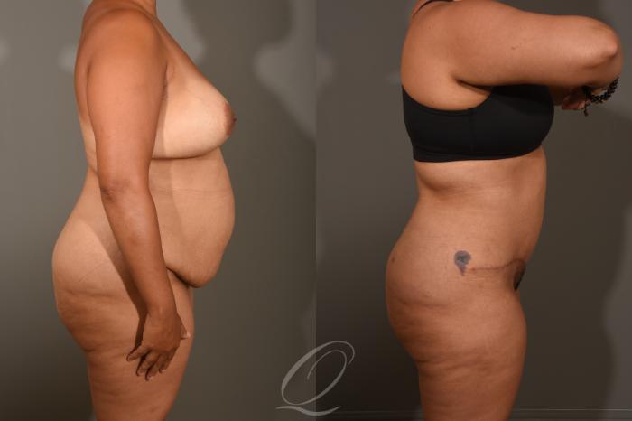 Tummy Tuck Case 405 Before & After Right Side | Serving Rochester, Syracuse & Buffalo, NY | Quatela Center for Plastic Surgery