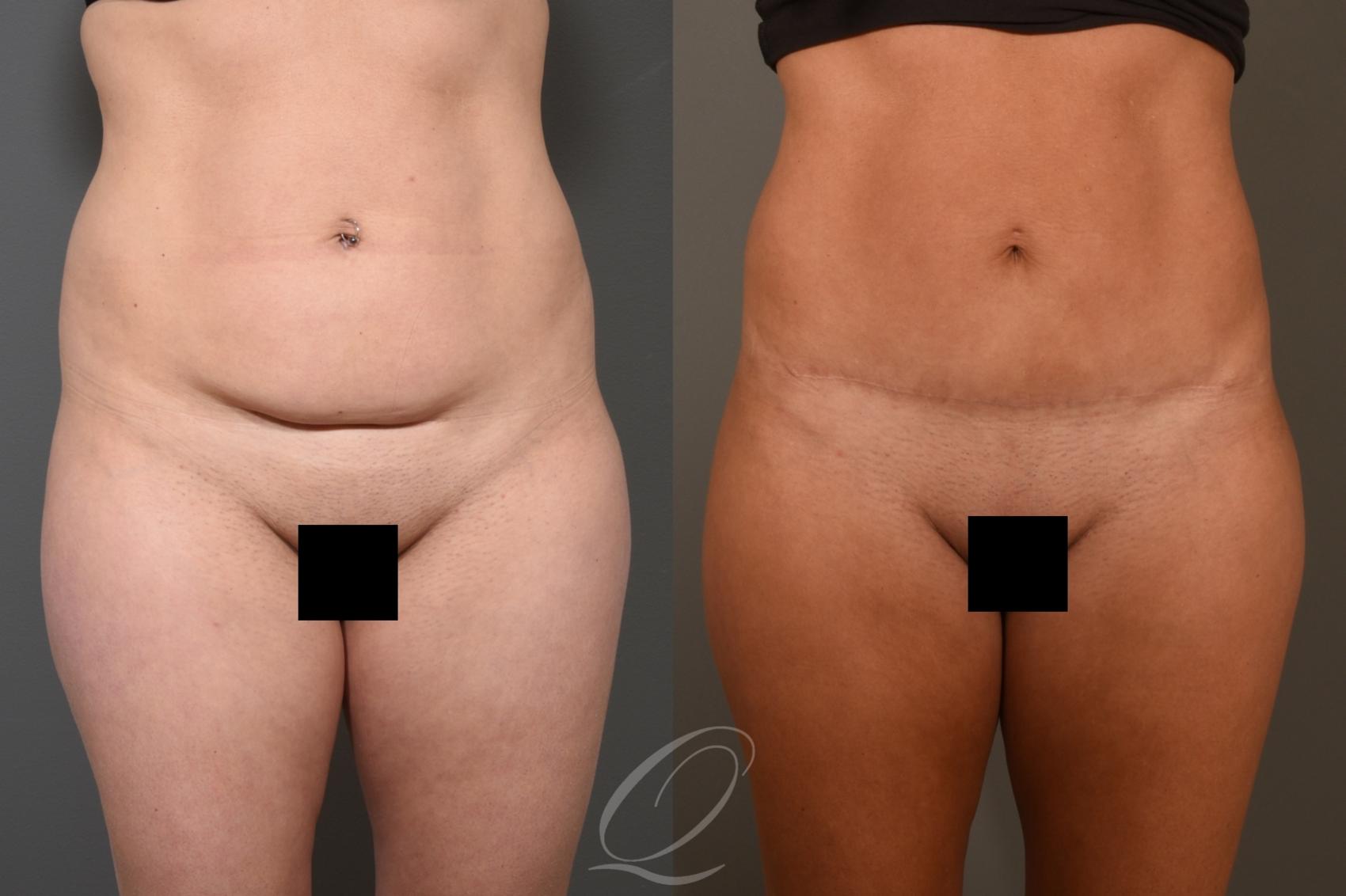 Tummy Tuck Case 406 Before & After Front | Serving Rochester, Syracuse & Buffalo, NY | Quatela Center for Plastic Surgery