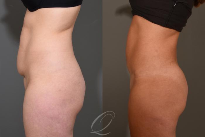 Tummy Tuck Case 406 Before & After Left Side | Serving Rochester, Syracuse & Buffalo, NY | Quatela Center for Plastic Surgery