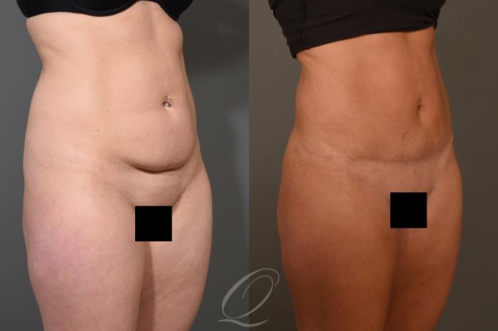 Tummy Tuck Case 406 Before & After Right Oblique | Serving Rochester, Syracuse & Buffalo, NY | Quatela Center for Plastic Surgery