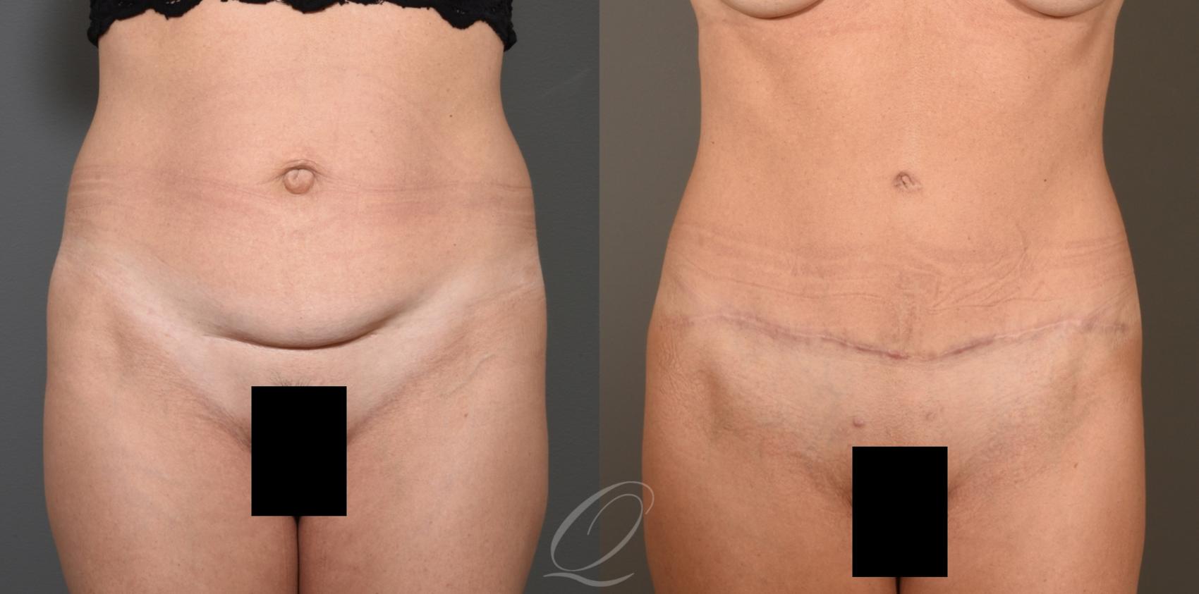 Tummy Tuck Case 407 Before & After Front | Serving Rochester, Syracuse & Buffalo, NY | Quatela Center for Plastic Surgery