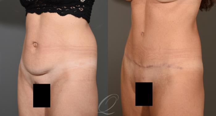 Tummy Tuck Case 407 Before & After Left Oblique | Serving Rochester, Syracuse & Buffalo, NY | Quatela Center for Plastic Surgery