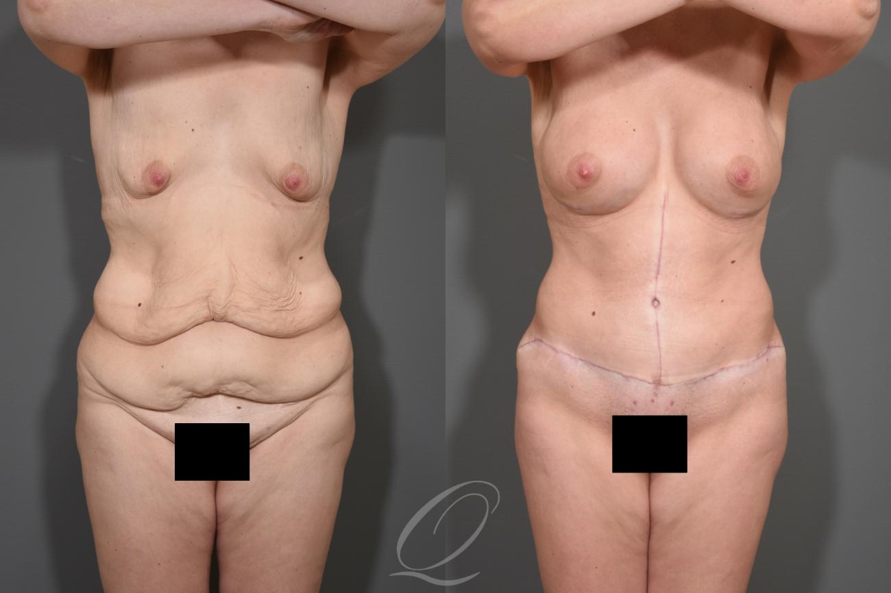 Tummy Tuck - Fleur de Lis Incision Case 343 Before & After View #1 | Serving Rochester, Syracuse & Buffalo, NY | Quatela Center for Plastic Surgery