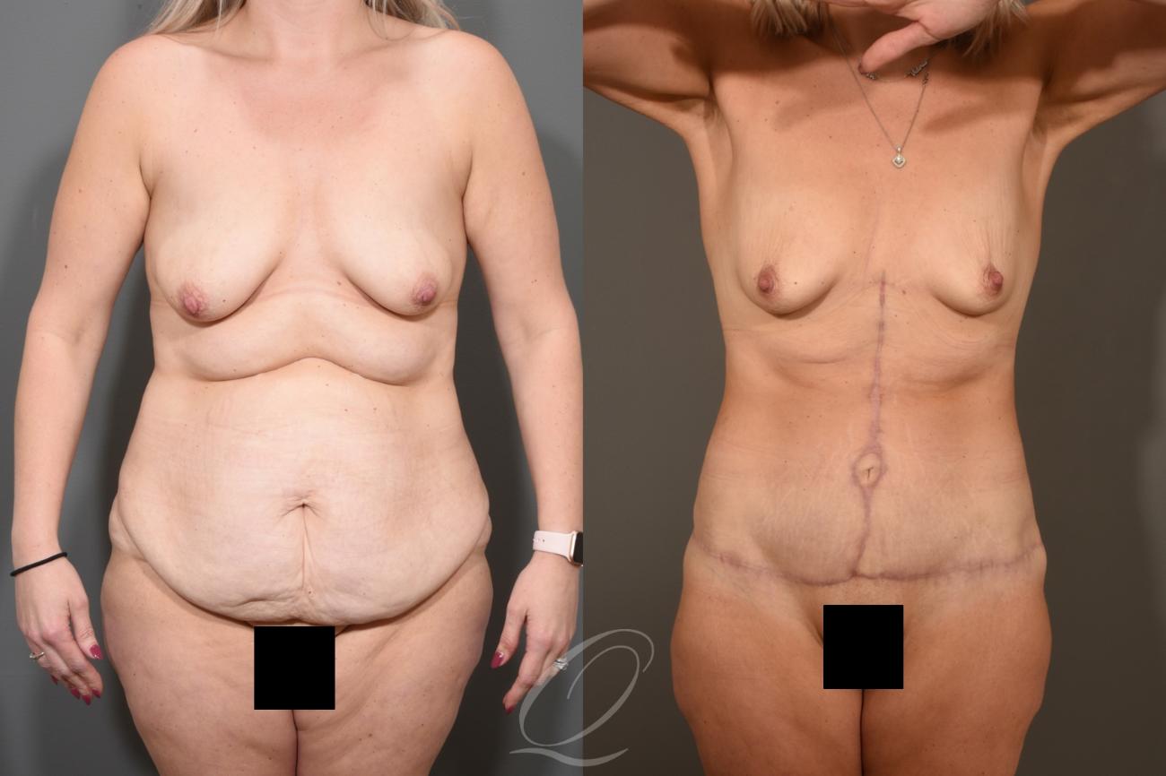 Tummy Tuck - Fleur de Lis Incision Case 411 Before & After Front | Serving Rochester, Syracuse & Buffalo, NY | Quatela Center for Plastic Surgery
