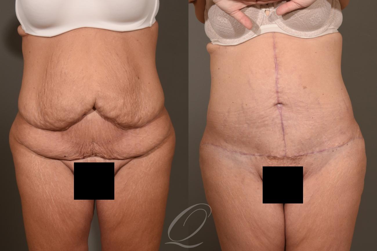 Tummy Tuck - Fleur de Lis Incision Case 412 Before & After Front | Serving Rochester, Syracuse & Buffalo, NY | Quatela Center for Plastic Surgery
