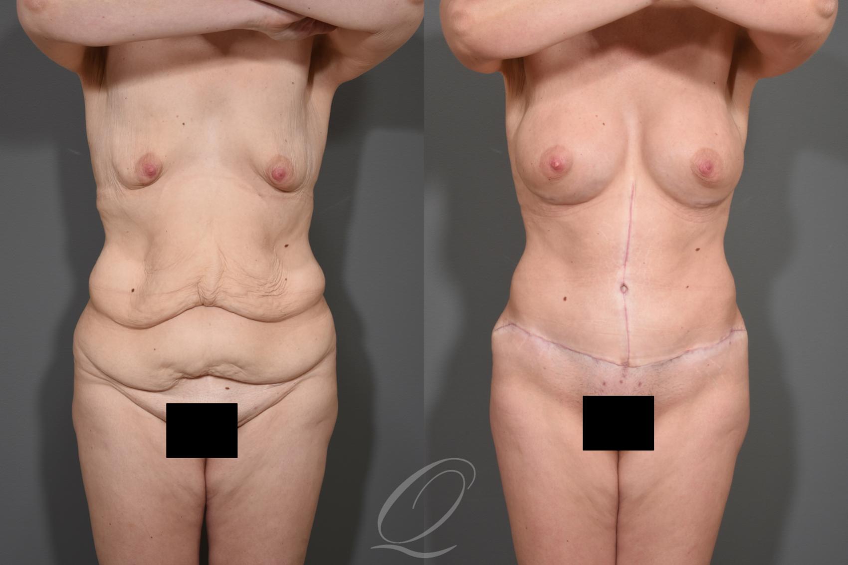 Breast Augmentation Case 343 Before & After View #1 | Serving Rochester, Syracuse & Buffalo, NY | Quatela Center for Plastic Surgery