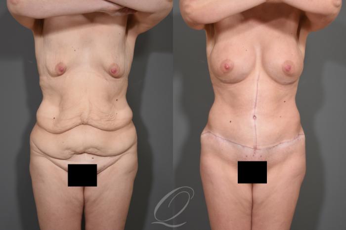 Tummy Tuck Case 343 Before & After View #1 | Serving Rochester, Syracuse & Buffalo, NY | Quatela Center for Plastic Surgery