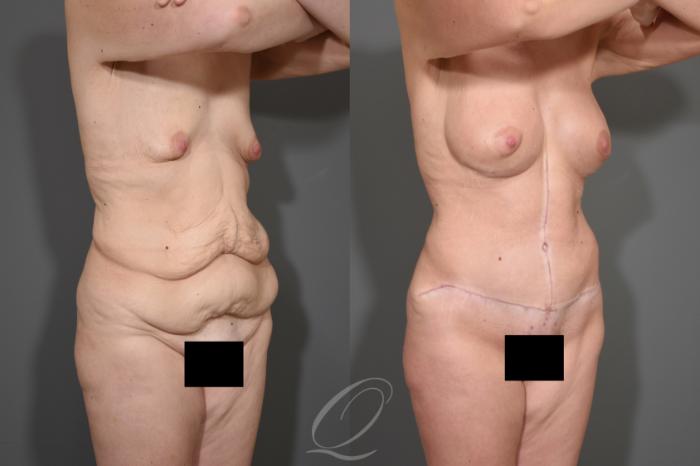 Tummy Tuck - Fleur de Lis Incision Case 343 Before & After View #2 | Serving Rochester, Syracuse & Buffalo, NY | Quatela Center for Plastic Surgery