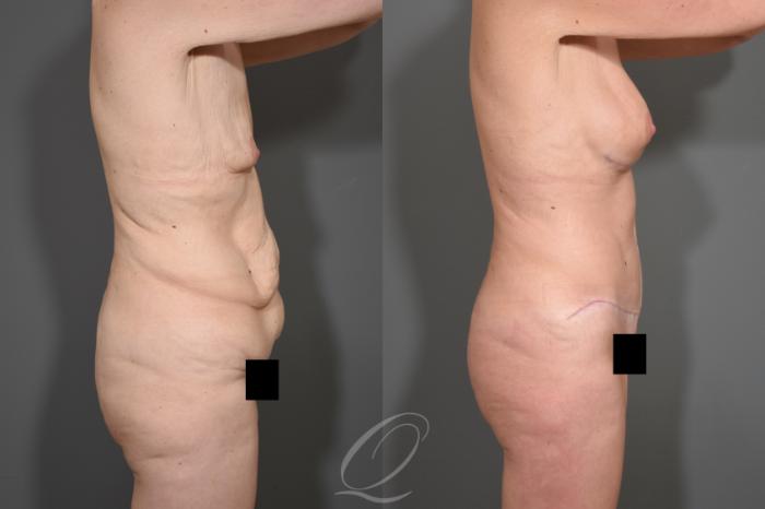 Tummy Tuck - Fleur de Lis Incision Case 343 Before & After View #3 | Serving Rochester, Syracuse & Buffalo, NY | Quatela Center for Plastic Surgery