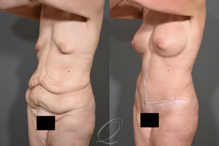 Tummy Tuck - Fleur de Lis Incision Case 343 Before & After View #4 | Serving Rochester, Syracuse & Buffalo, NY | Quatela Center for Plastic Surgery