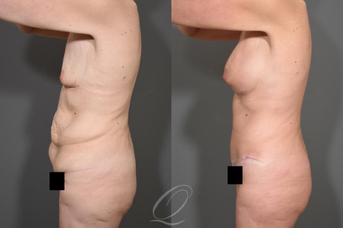 Tummy Tuck - Fleur de Lis Incision Case 343 Before & After View #5 | Serving Rochester, Syracuse & Buffalo, NY | Quatela Center for Plastic Surgery