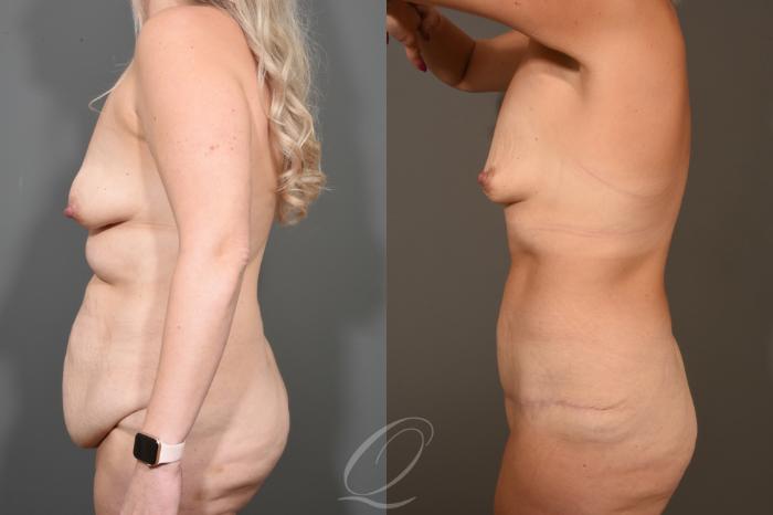 Tummy Tuck - Fleur de Lis Incision Case 411 Before & After Left Side | Serving Rochester, Syracuse & Buffalo, NY | Quatela Center for Plastic Surgery