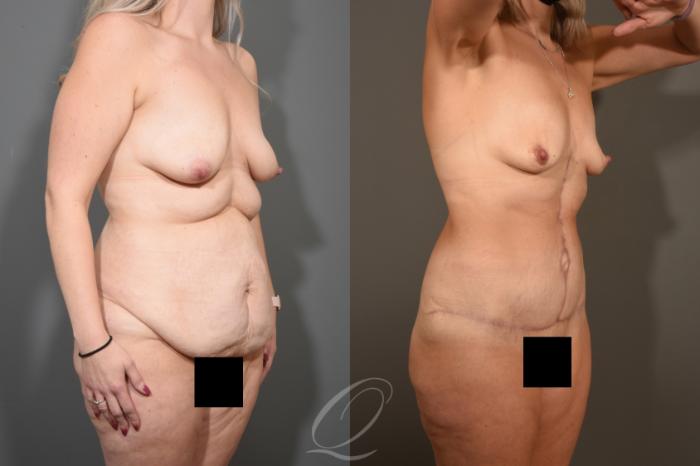 Tummy Tuck - Fleur de Lis Incision Case 411 Before & After Right Oblique | Serving Rochester, Syracuse & Buffalo, NY | Quatela Center for Plastic Surgery