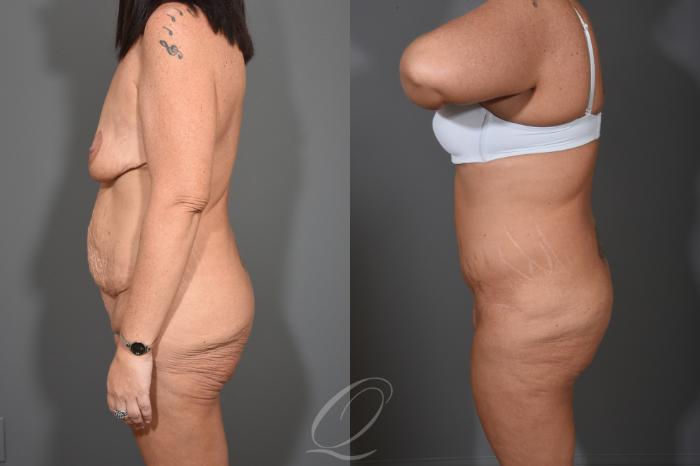 Tummy Tuck - Fleur de Lis Incision Case 412 Before & After Left Side | Serving Rochester, Syracuse & Buffalo, NY | Quatela Center for Plastic Surgery