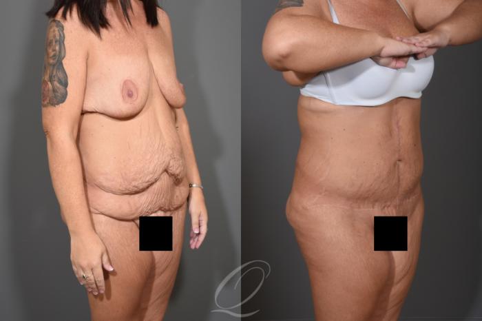 Tummy Tuck - Fleur de Lis Incision Case 412 Before & After Right Oblique | Serving Rochester, Syracuse & Buffalo, NY | Quatela Center for Plastic Surgery