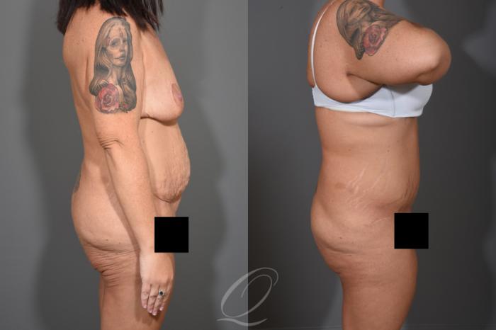 Tummy Tuck - Fleur de Lis Incision Case 412 Before & After Right Side | Serving Rochester, Syracuse & Buffalo, NY | Quatela Center for Plastic Surgery