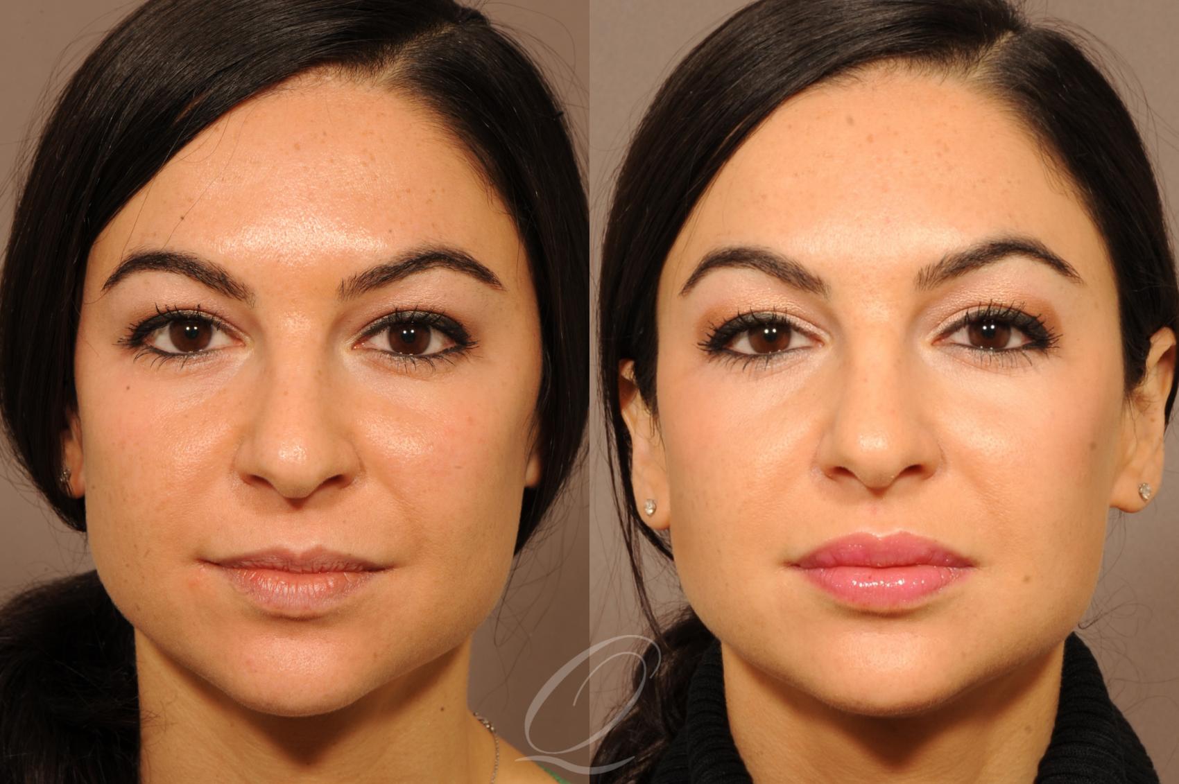 Juvederm™ Case 226 Before & After View #1 | Serving Rochester, Syracuse & Buffalo, NY | Quatela Center for Plastic Surgery