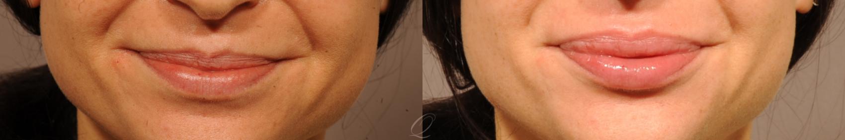 Voluma® Case 226 Before & After View #3 | Serving Rochester, Syracuse & Buffalo, NY | Quatela Center for Plastic Surgery